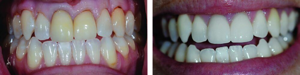 Two Front Teeth Veneers and Teeth Whitening to Remove Yellow Staining Two Front Teeth Veneers and Teeth Whitening to Remove Yellow Staining