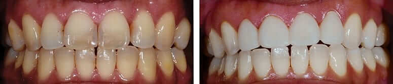 Veneers and Teeth Whitening