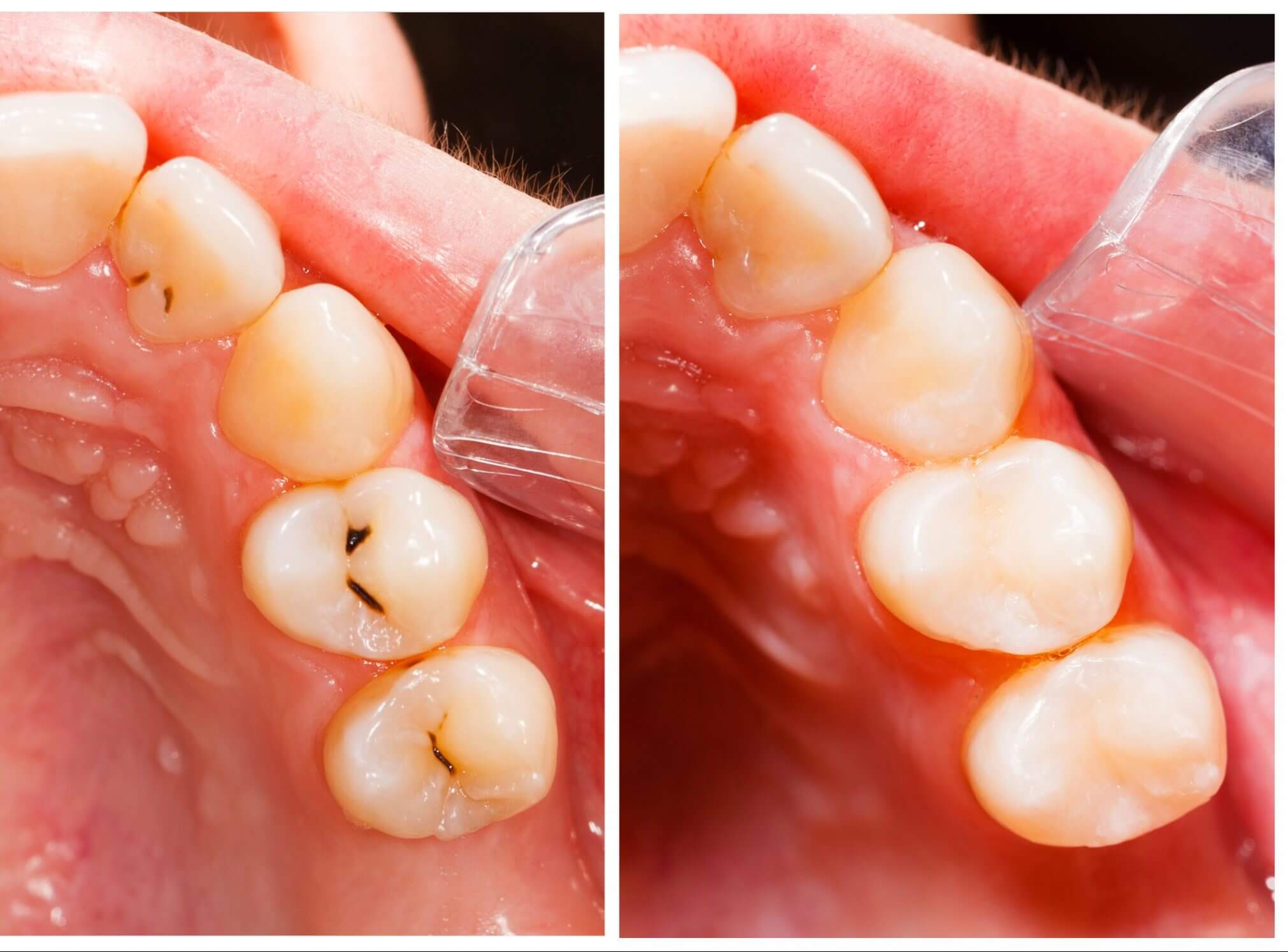 what does a cavity look like? what does a cavity look like?